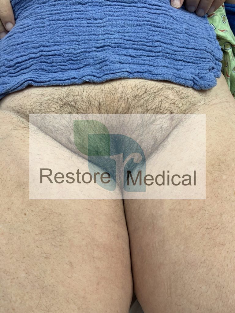 Male to Female Bottom Surgery Results 9