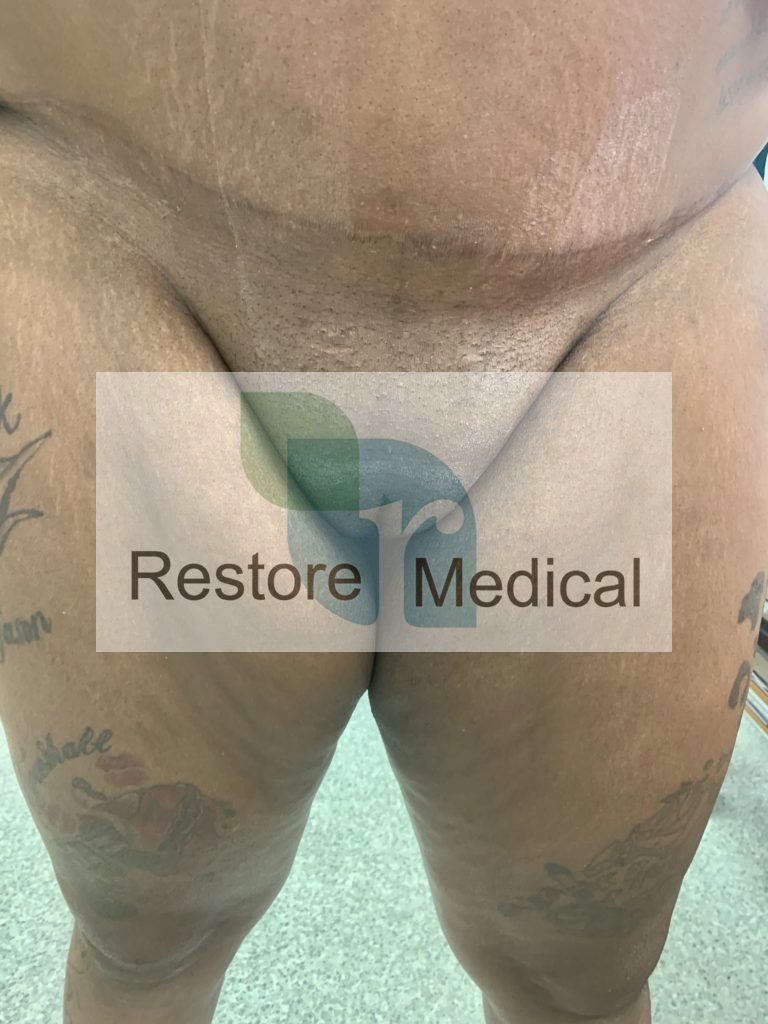 Male to Female Bottom Surgery Results 6