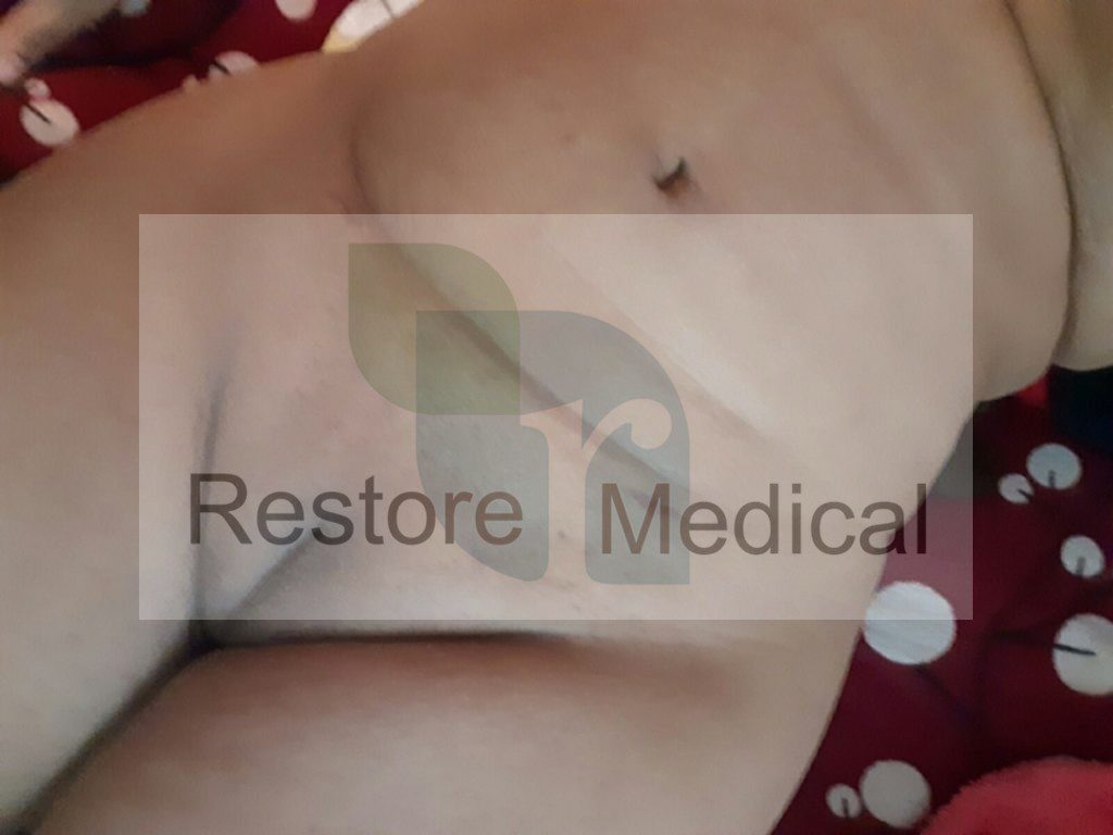 Male to Female Bottom Surgery Results 4