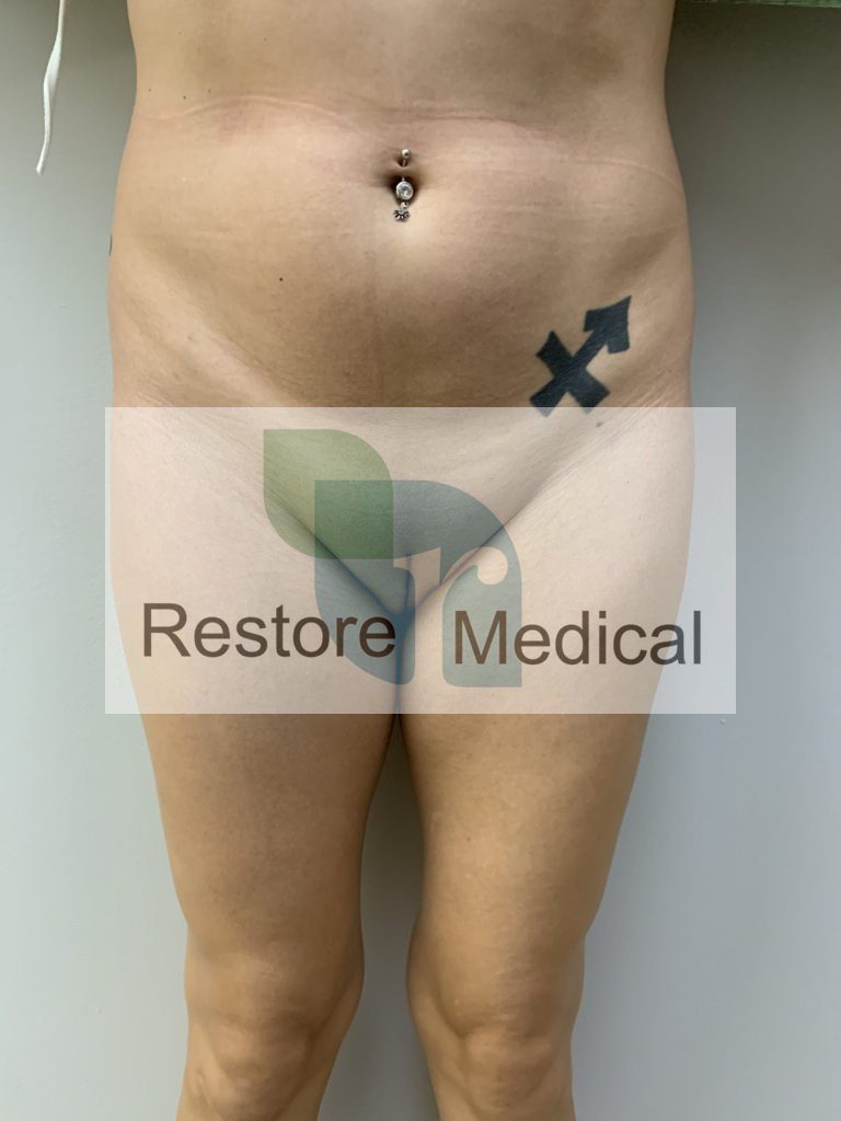Male to Female Bottom Surgery Results 3